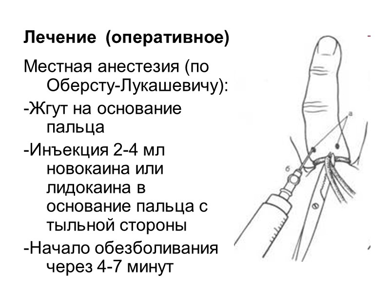 Лечение  (оперативное) Местная анестезия (по Оберсту-Лукашевичу): -Жгут на основание пальца -Инъекция 2-4 мл